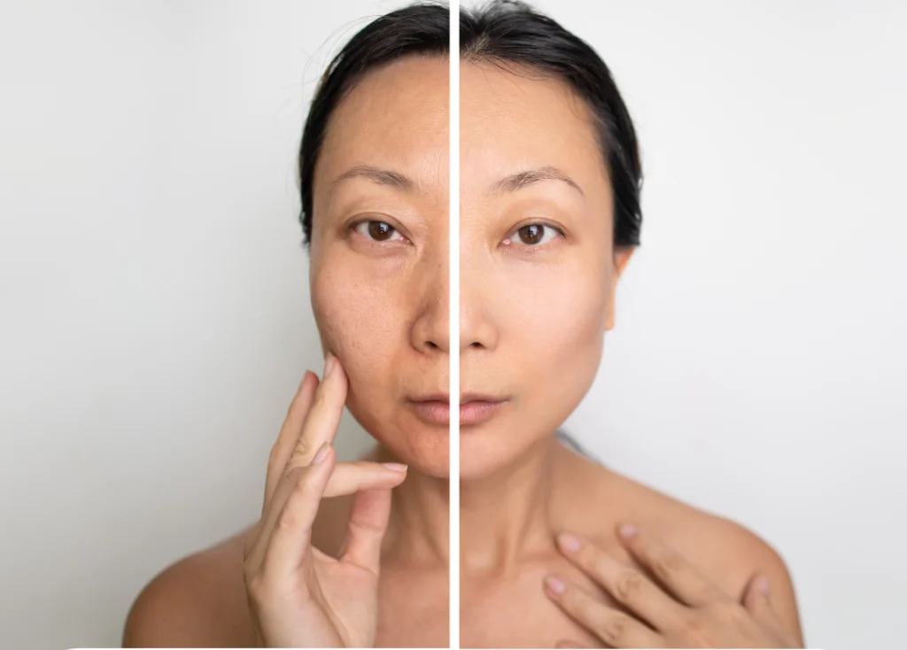 Microneedling before and after results on female face.