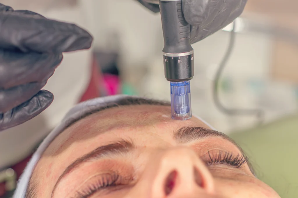 Microneedling procedure being performed on forehead.