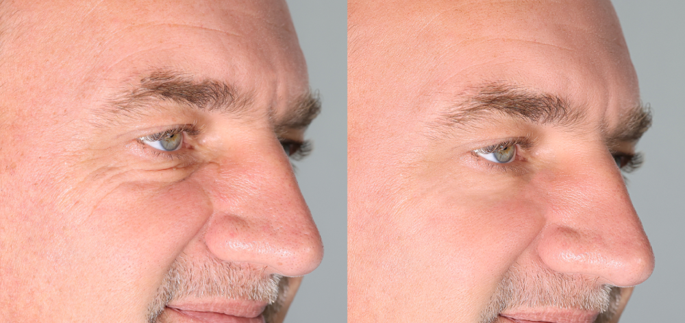 Man's face before and after Botox treatment.