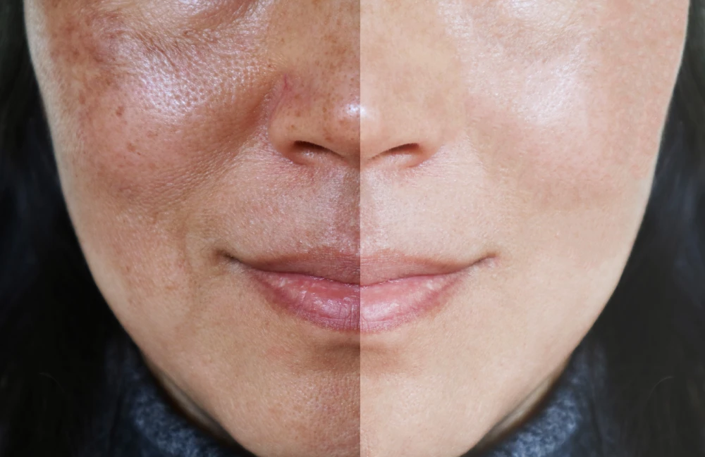 IPL treatment before and after showing reduced age spots.