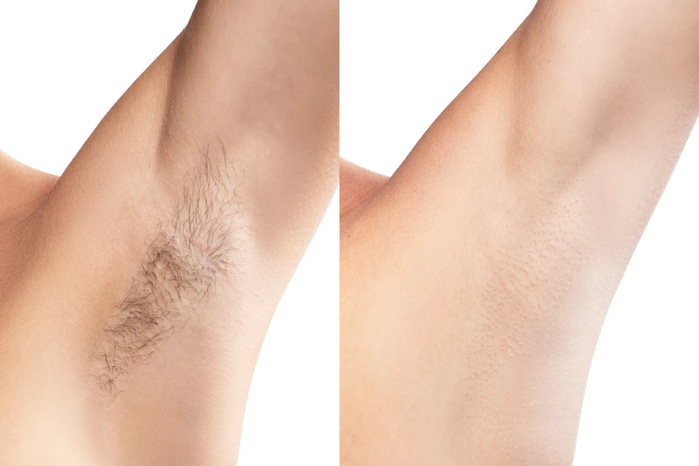 Before and after laser hair removal on underarms.
