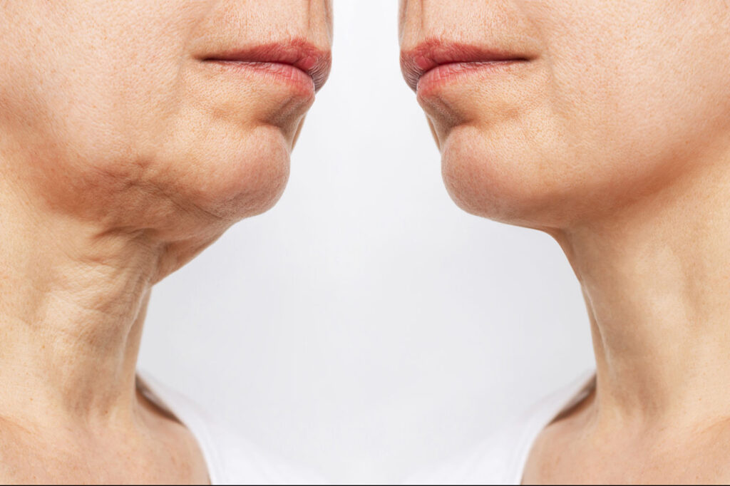 Side-by-side before and after showing improved chin and jawline definition using injectables.