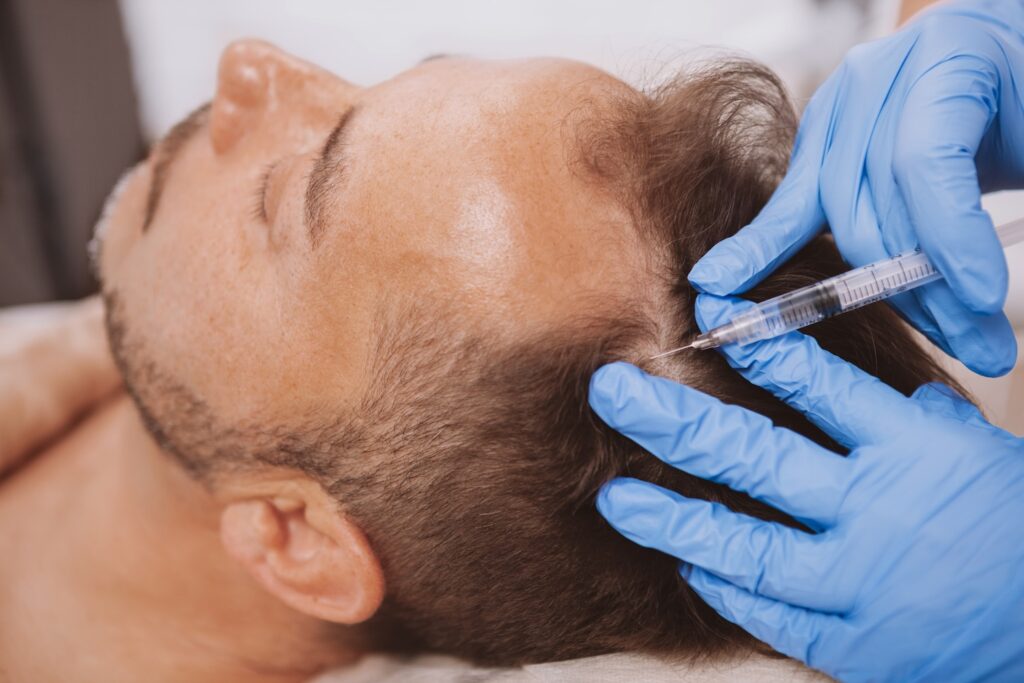 Gloved hands administering a syringe injection into a man’s scalp as he lies on a treatment bed.