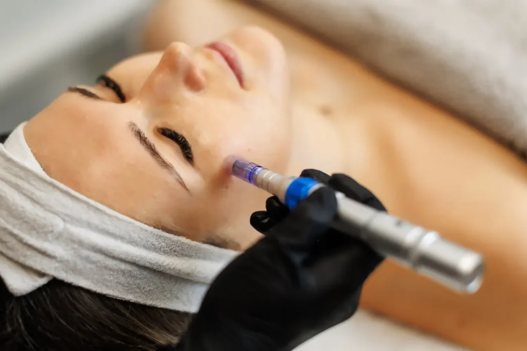 microneedling facial treatment for smoother skin before wedding