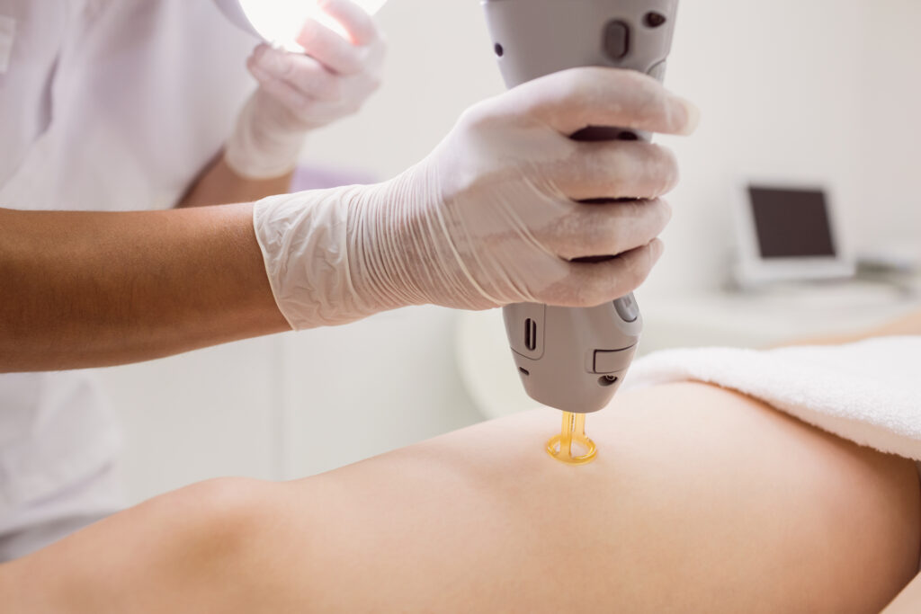 Gloved hands using laser device on skin during treatment