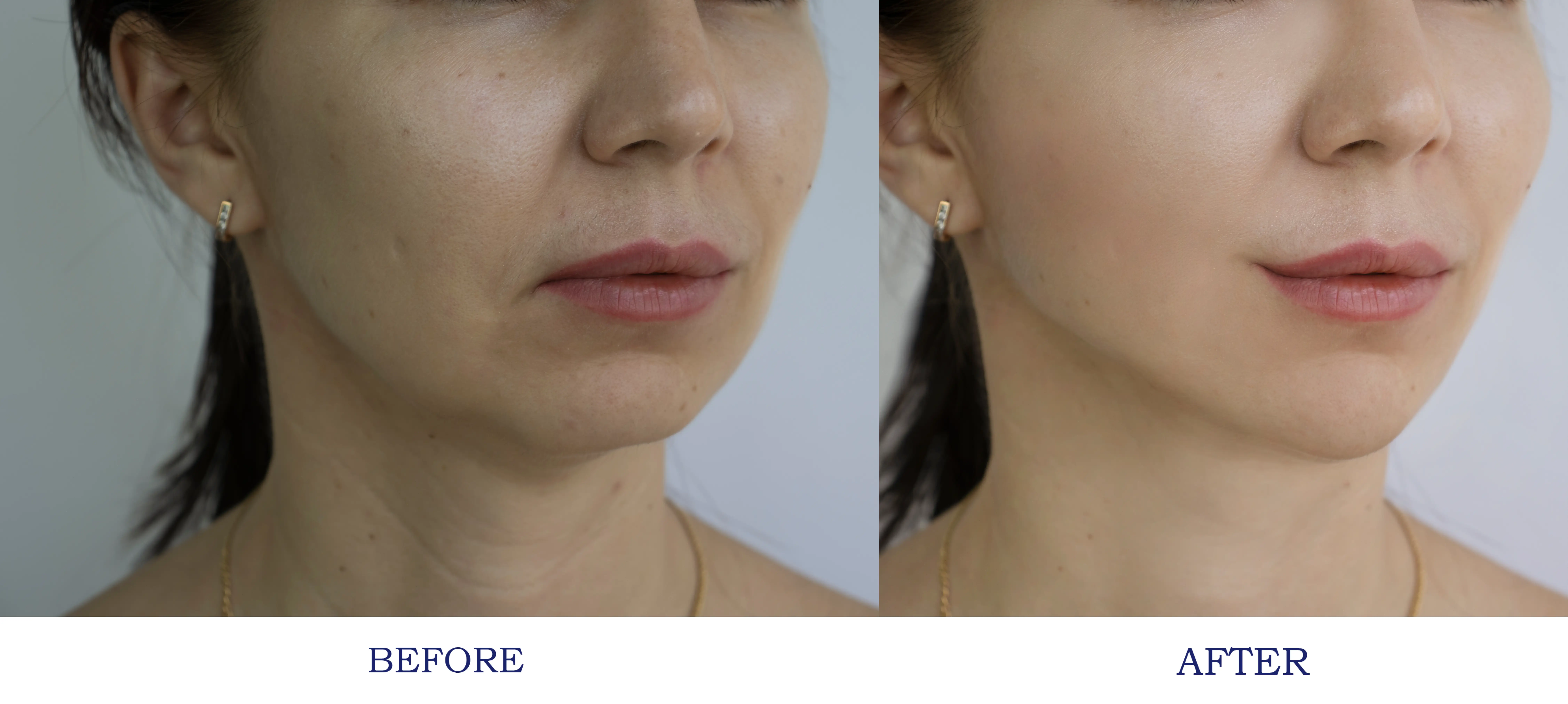 Left and right facial images compare cheek contour, midface volume, and lower face definition under similar lighting.