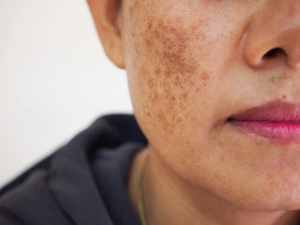 Close-up of a person's cheek showing clusters of visible dark pigmentation spots and natural skin texture.