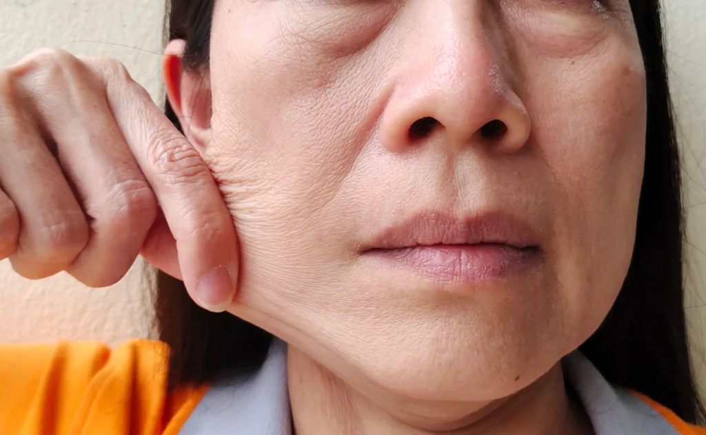 Close-up of a person gently pulling the cheek to show visible skin laxity and facial folds.