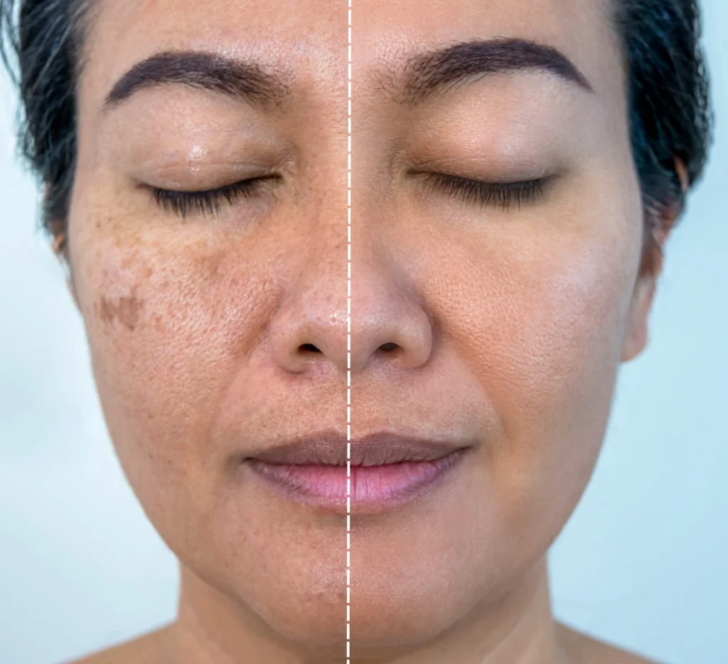 Left and right facial images compare visible dark spots, skin tone, and cheek pigmentation under similar lighting.